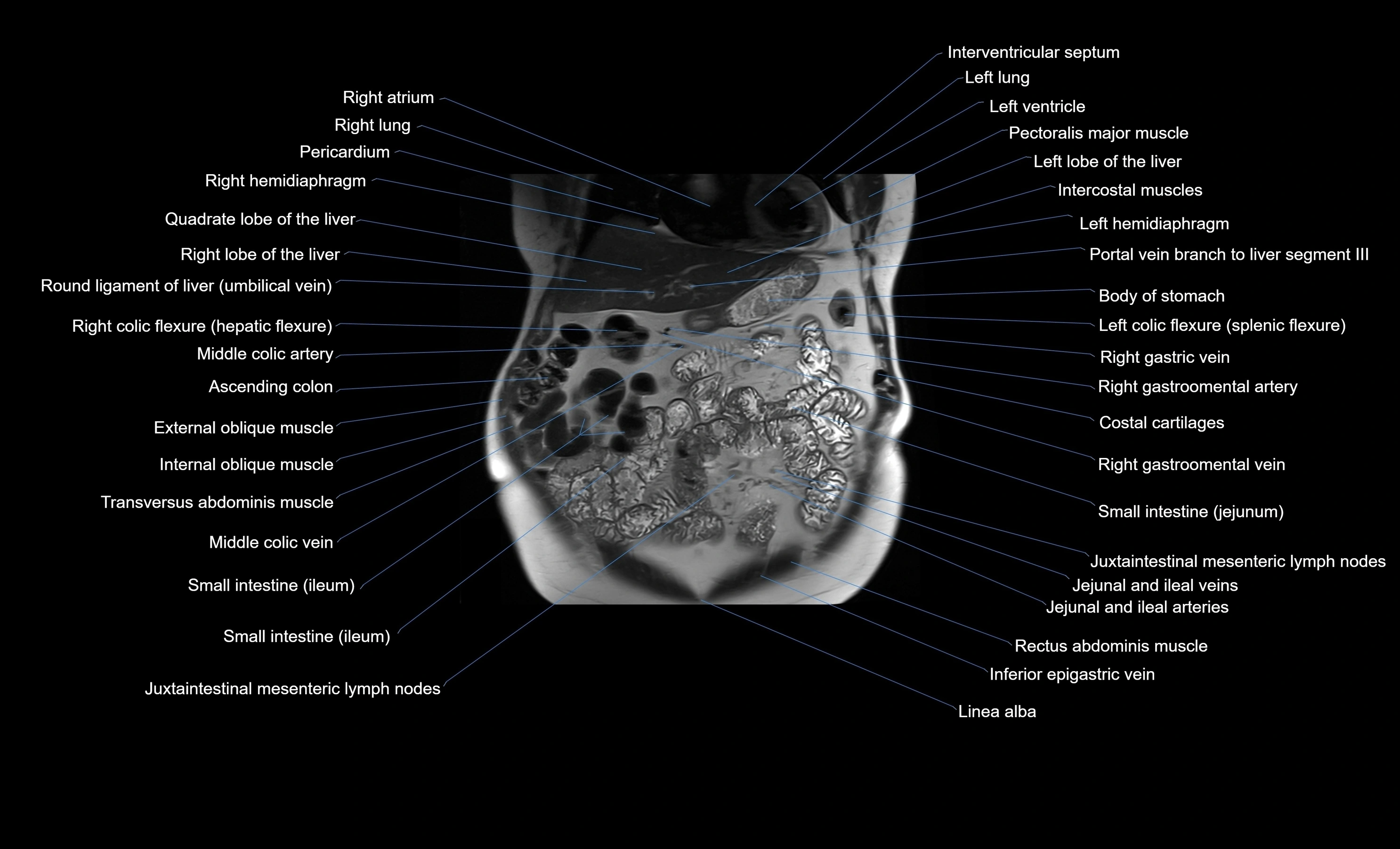 MRI Abdomen coronal labelled cross sectional anatomy radiology  image-img-00001-00017.webp